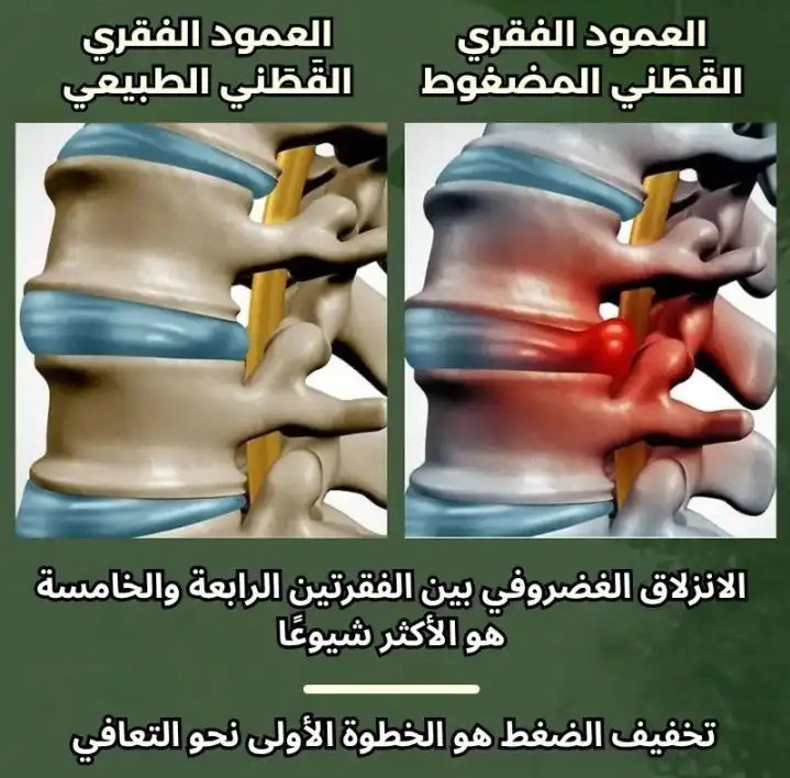 بخاخ الإغاثة الفوري لإنهاء الألم